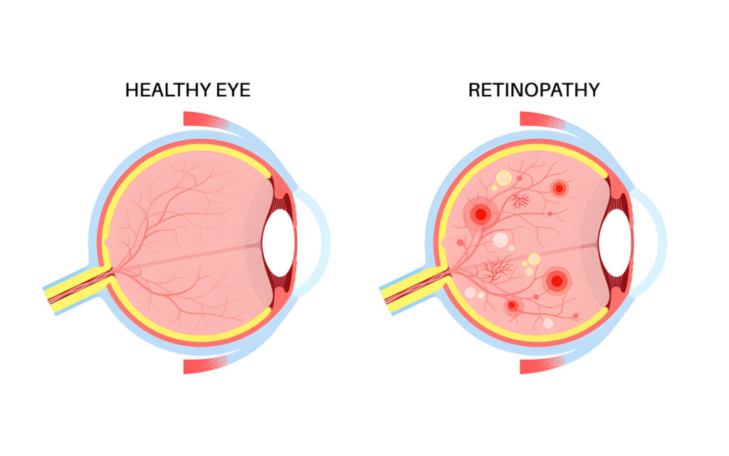 Differenza tra occhio sano e con retinopatia diabetica – trattamenti a Milano