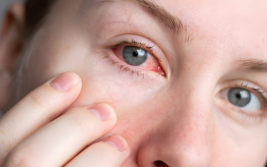 Primo piano occhi con sindrome occhio secco &ndash; diagnosi e cure a Milano