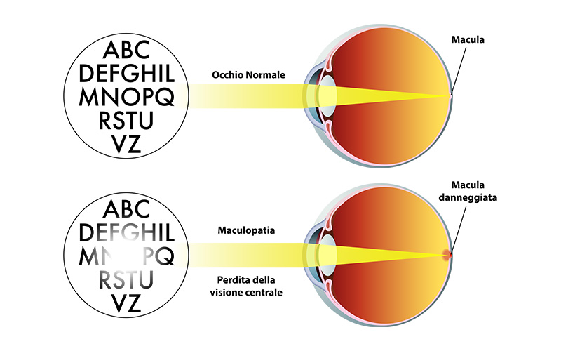 Cos’è la maculopatia e come si vede con la macula danneggiata
