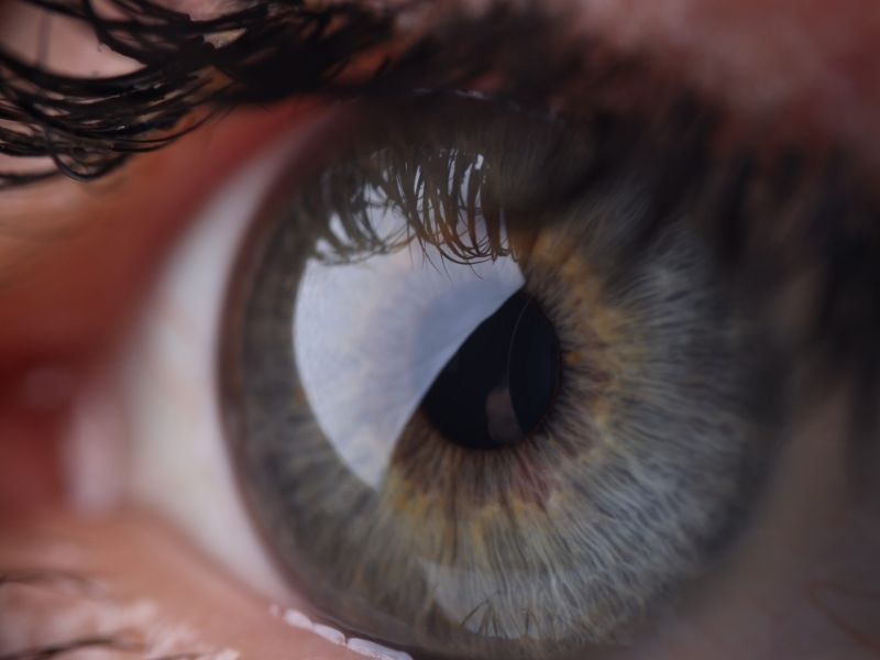 SMILE vs LASIK e PRK_ quali differenze